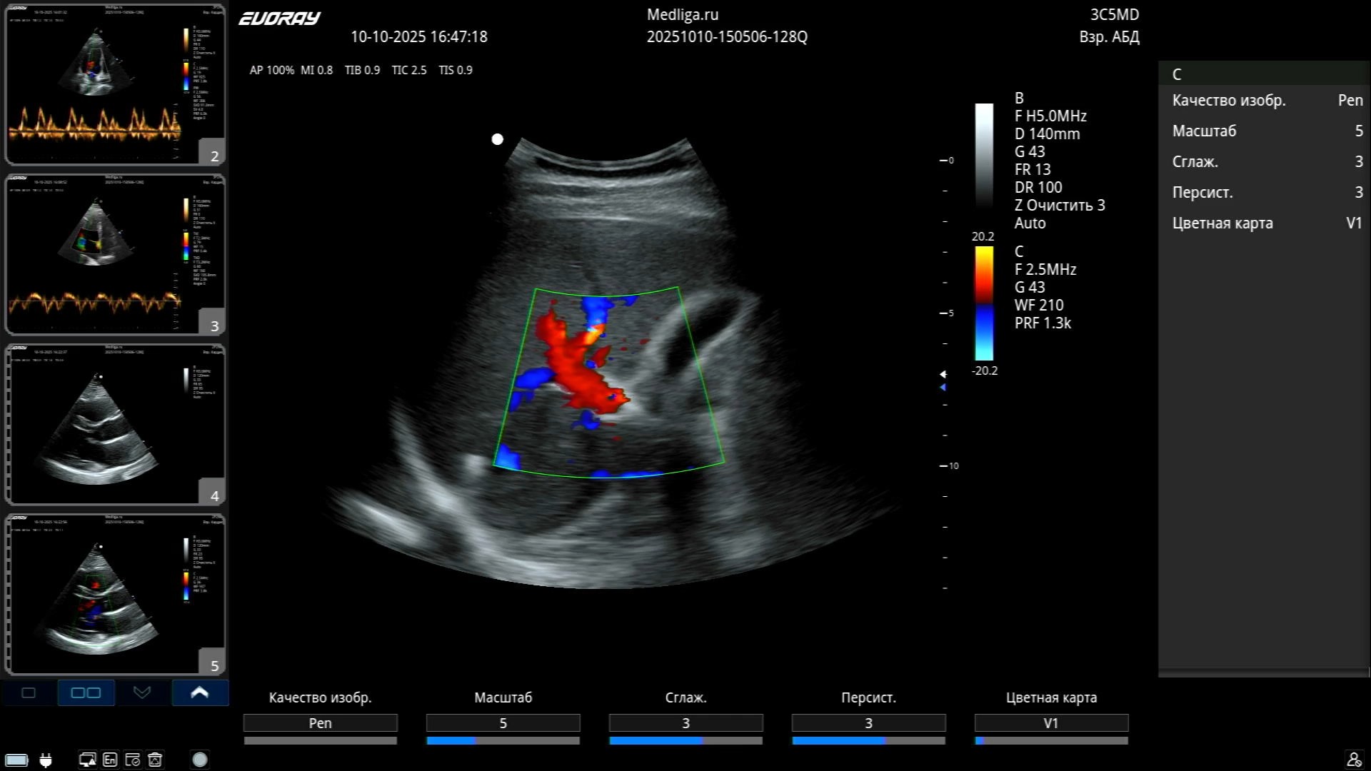 Четырехкамерный апикальный срез сердца в режиме тканевого допплера TVI (Tissue Velocity Imaging)